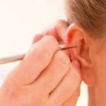 Fig. 6A Stimolazione auricolare impressoria.