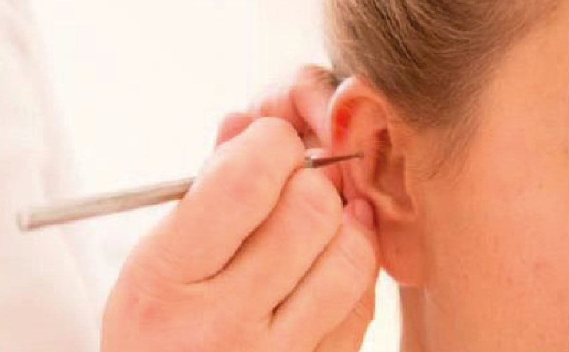 Fig. 6A Stimolazione auricolare impressoria.