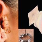 Fig. 6B Stimolazione auricolare con mini aghetti.