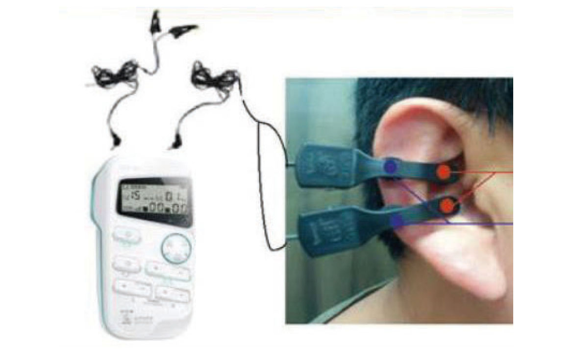 Fig. 6C Stimolazione auricolare con T.E.N.S.