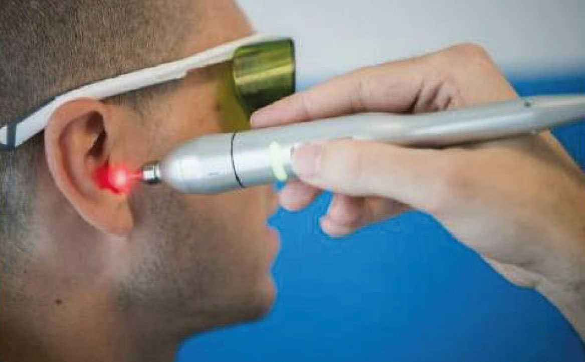 Fig. 6D Stimolazione auricolare con laser.