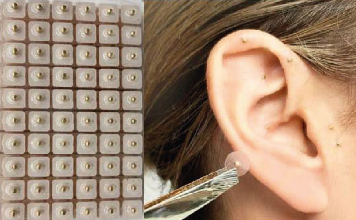 Fig. 7B Metodi di stimolazione auricolare con sferette magnetiche.