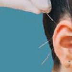 Fig. 7C Metodi di stimolazione auricolare con aghi intradermici.