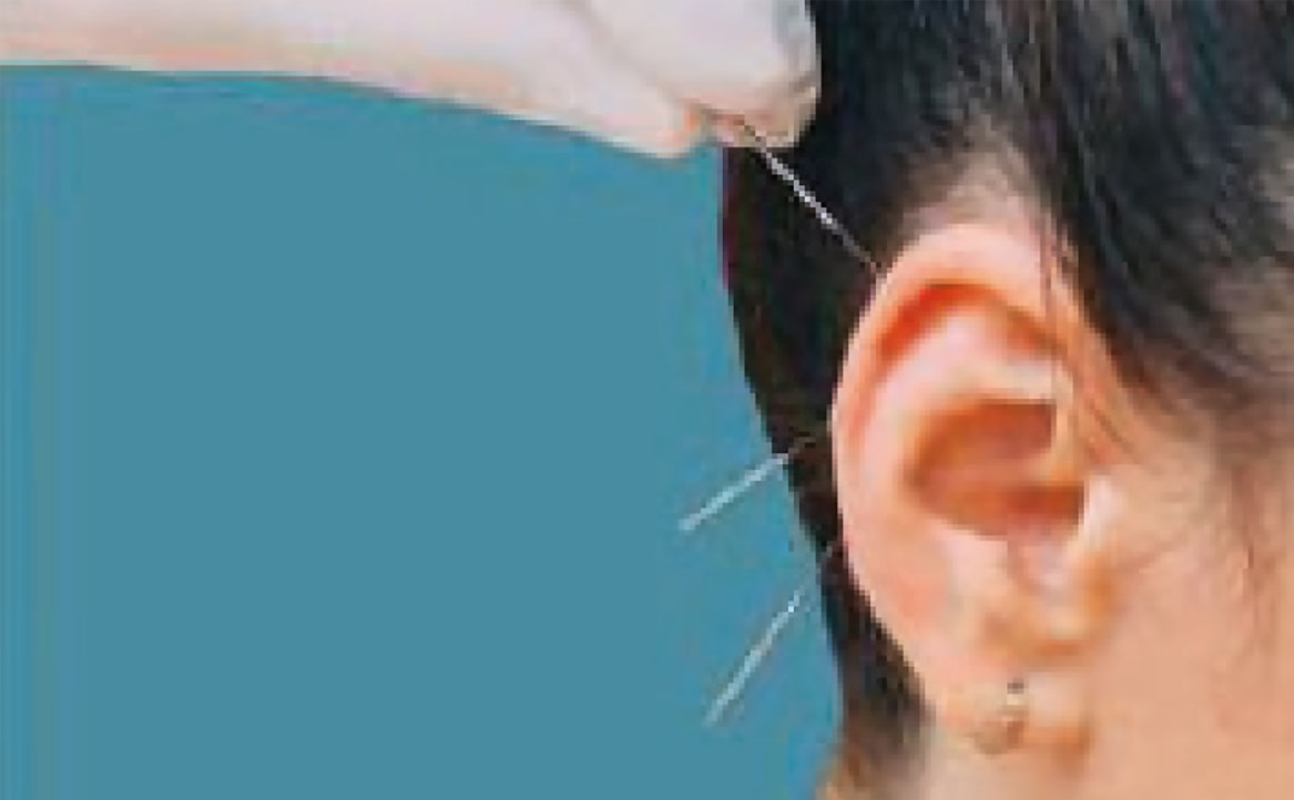 Fig. 7C Metodi di stimolazione auricolare con aghi intradermici.