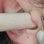 Fig. 10 Stimolazione del Punto Zero Secondario.