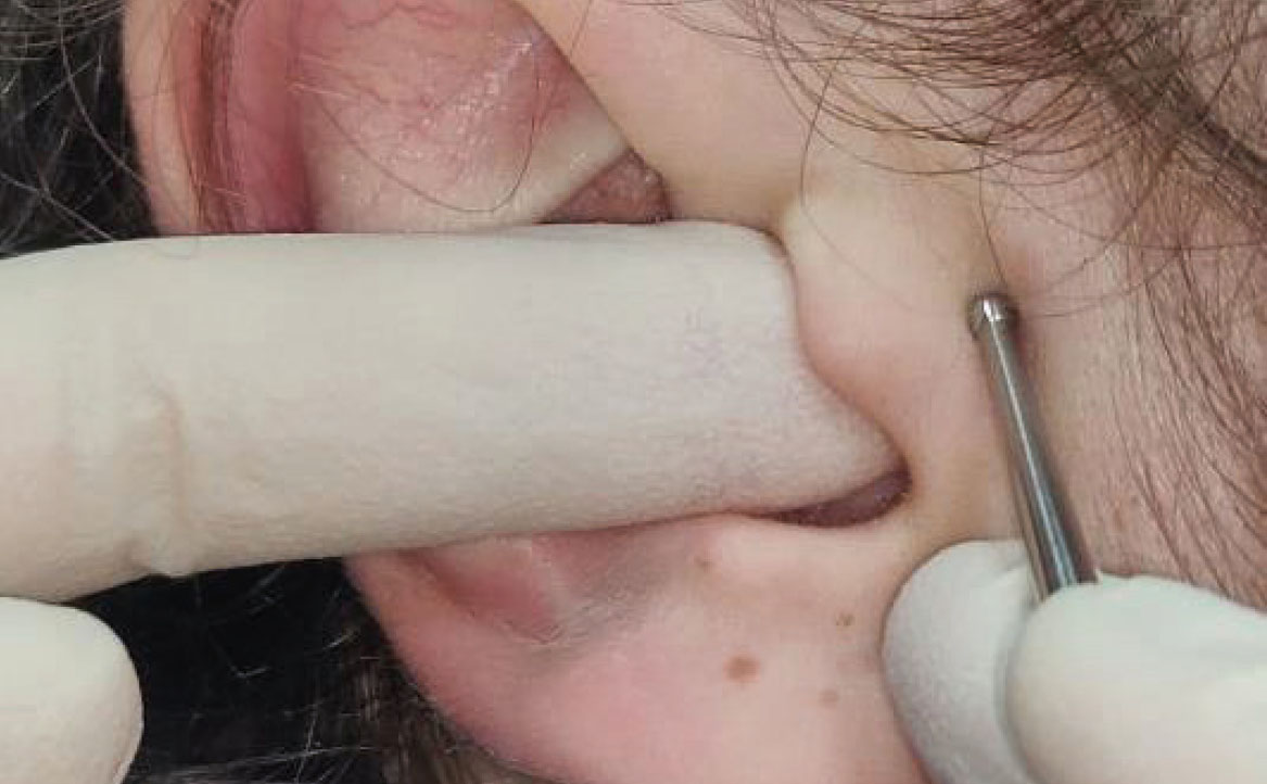 Fig. 10 Stimolazione del Punto Zero Secondario.