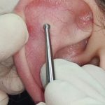 Fig. 11 Stimolazione del punto Shen Men.