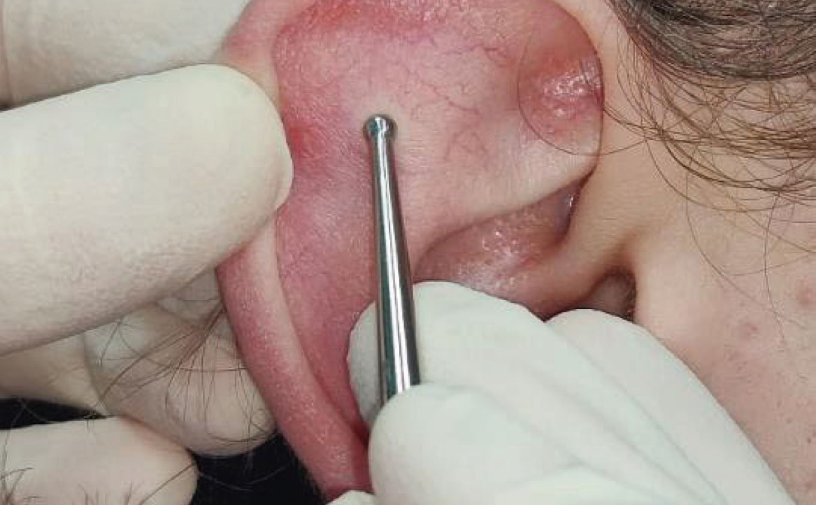 Fig. 11 Stimolazione del punto Shen Men.