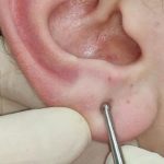 Fig. 12 Stimolazione del punto Maestro Sensoriale.