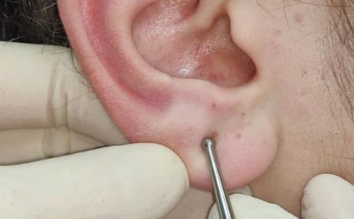 Fig. 12 Stimolazione del punto Maestro Sensoriale.