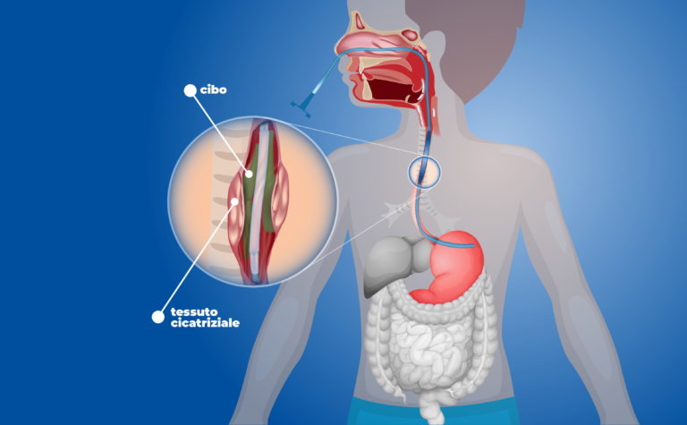 Dal Bambino Gesù stent dinamico per le lesioni esofagee