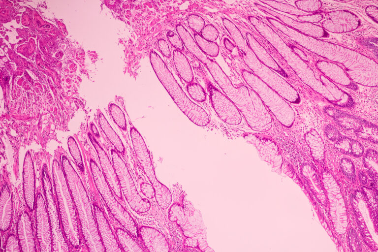 Tumore del pancreas duttale, calcolatore stratifica rischio recidiva