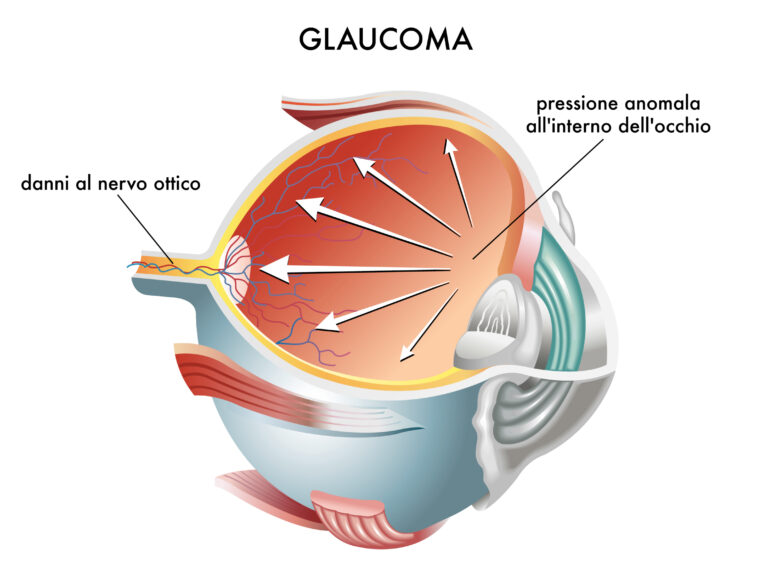 Glaucoma, diagnosi e follow-up migliori con software di ultima generazione
