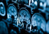 Tumori cerebrali, all’Irccs Neuromed termoablazione laser integrata con il monitoraggio anatomo-funzionale