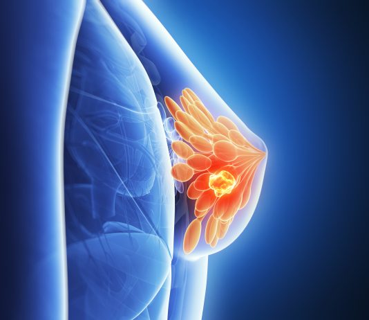 Monitoraggio di Breast Unit e Pdta oncologici in Lombardia