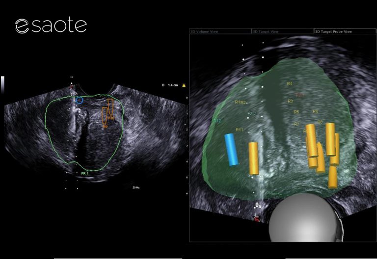 UroFusion, software avanzato di fusion imaging per biopsia prostatica target