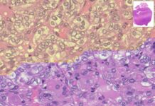 L’ausilio dell’IA per migliorare la diagnosi dei tumori