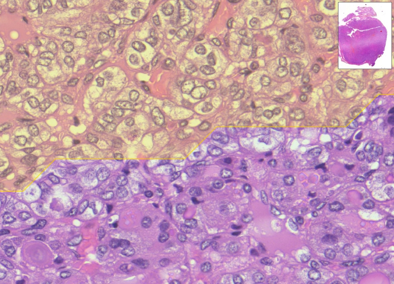 L’ausilio dell’IA per migliorare la diagnosi dei tumori