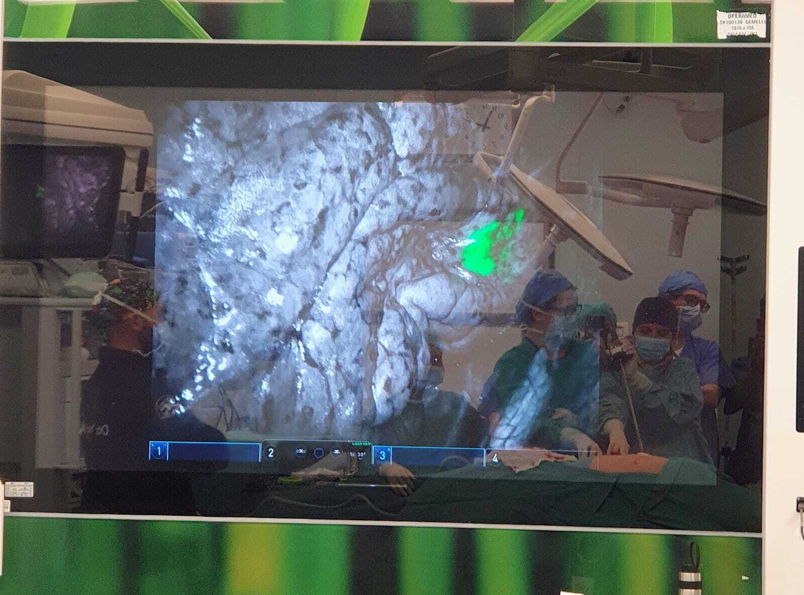 Tumore al polmone: dal sospetto diagnostico all’intervento in meno di quattro ore