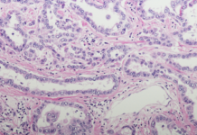 mesotelioma pleurico carcinosi pleurica PITAC