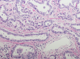 Chemioterapia intratoracica per la gestione della carcinosi pleurica mesotelioma pleurico carcinosi pleurica PITAC
