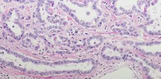 mesotelioma pleurico carcinosi pleurica PITAC