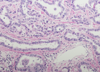 mesotelioma pleurico carcinosi pleurica PITAC