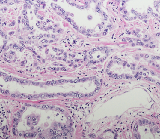 mesotelioma pleurico carcinosi pleurica PITAC