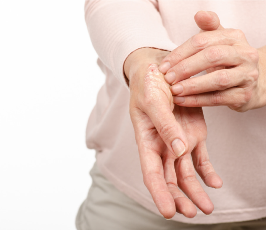 (H) Open day sulla psoriasi