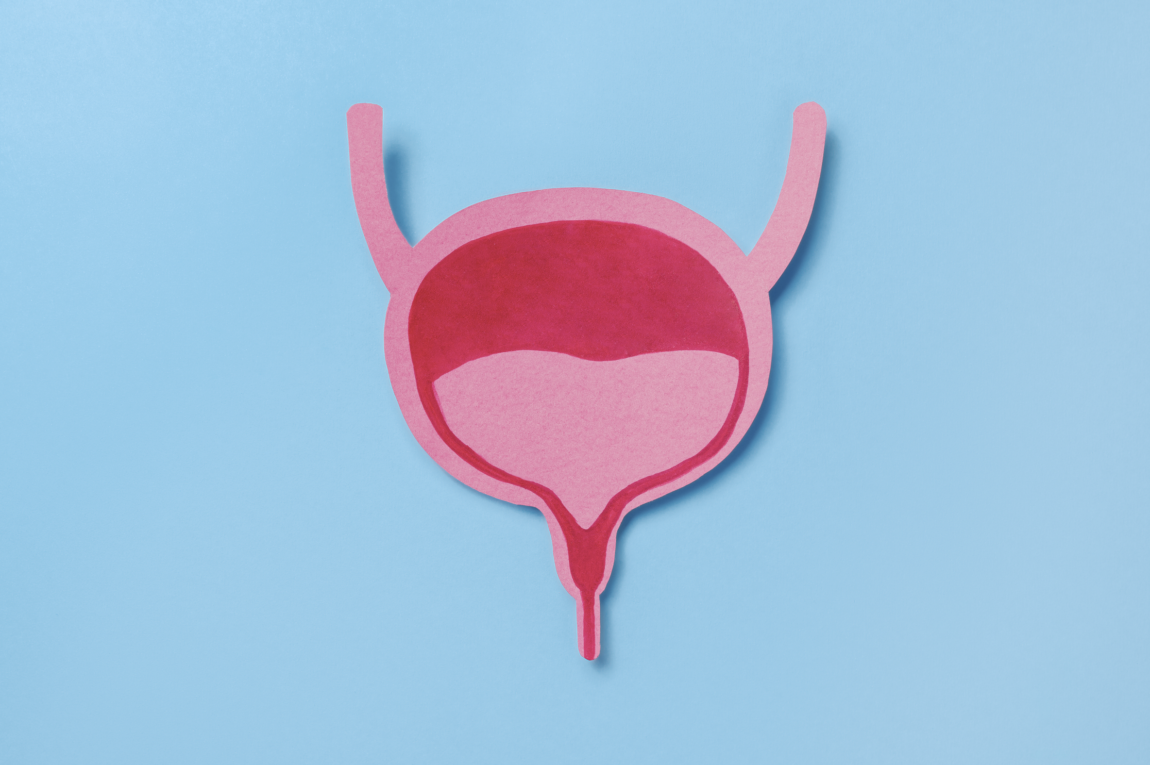 Carcinoma uroteliale, dispositivo per rilascio costante di chemioterapico