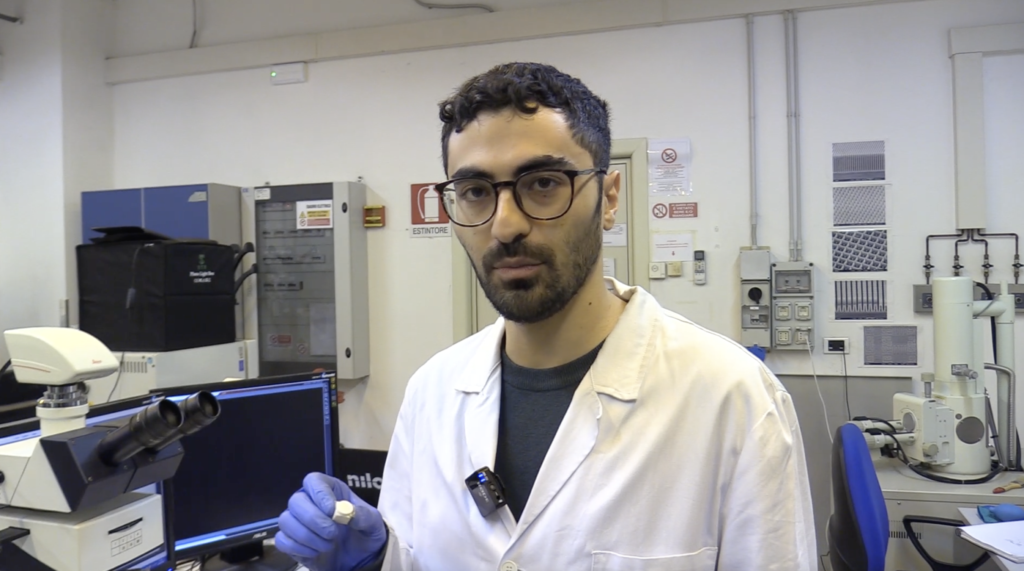microaghi digitali biomarcatori Alzheimer diagnosi precoce